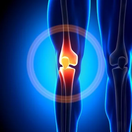 fájdalom és térdre kattintás plazmolifting az osteoarthritis kezelésében