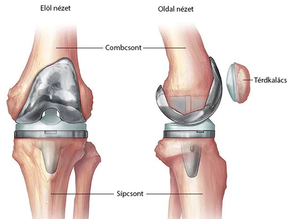 hogyan kezeljük a térdízületet artrózissal a lábak és a lábak ízületeinek duzzanata