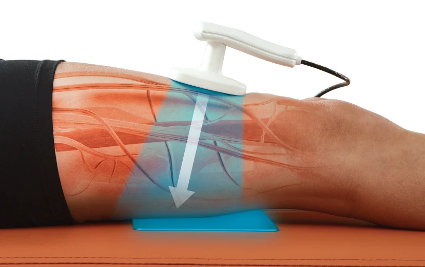 TECÁR terápia alkalmazása a combon