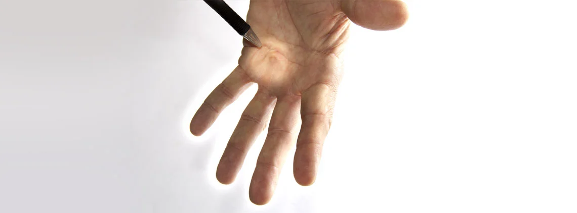 Dupuytren kontraktúra