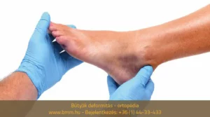 Bütyök deformitás