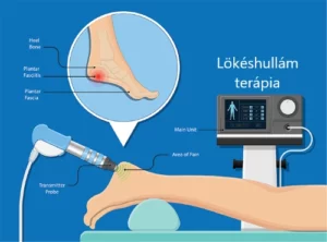 Lökéshullám terápia