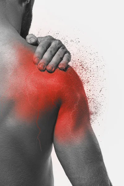 Befagyott váll szindróma