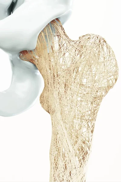 Csípőfájdalom egyik okozója lehet csontritkulás is