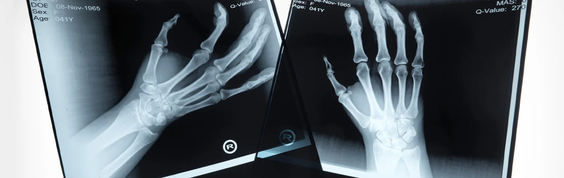 Csukló és sajkacsonttörés esetén röntgen felvétel készül