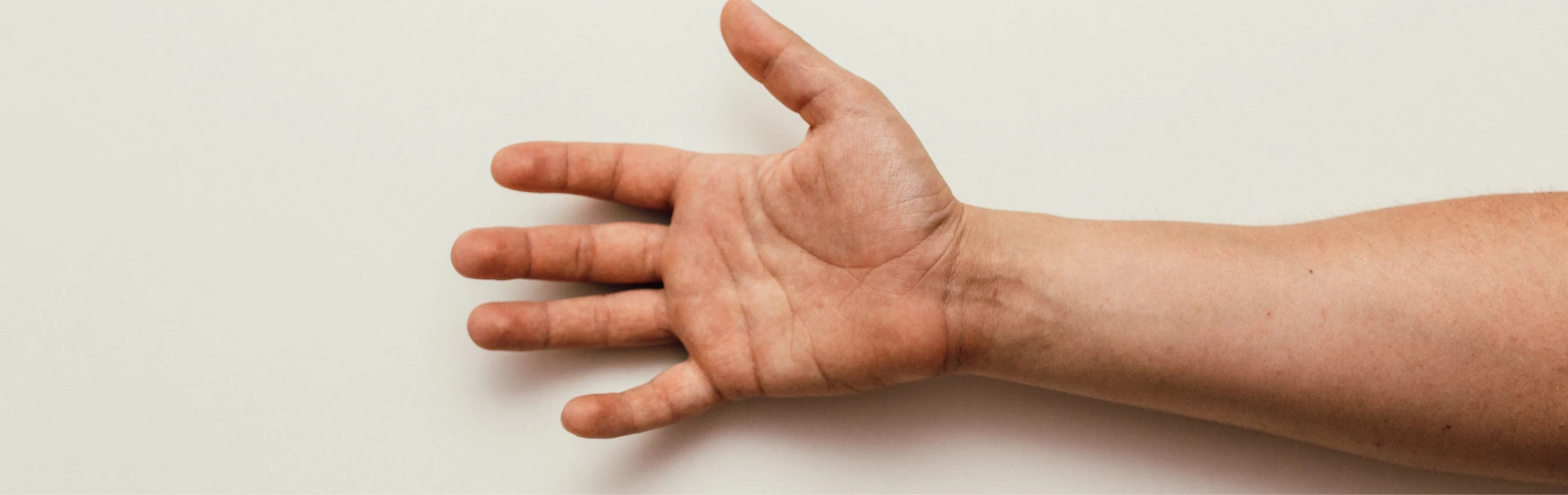 Gyógyulástörténet - Dupuytren kontraktúra Gyógyulástörténet - Dupuytren kontraktúra