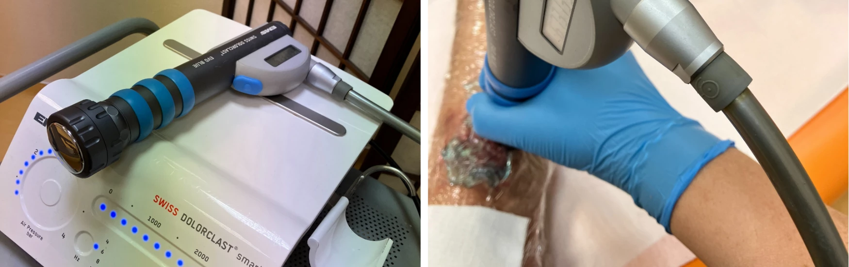 Sebkezelés lökéshullám terápiával