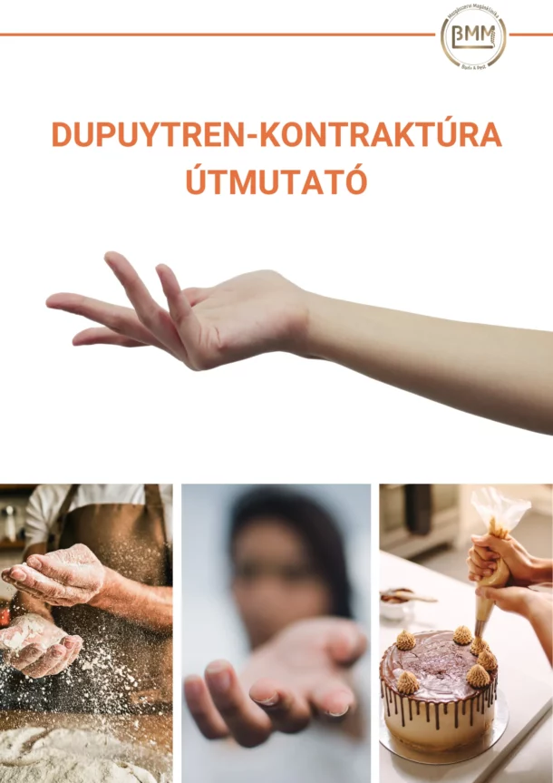 Dupuytren-kontraktúra útmutató