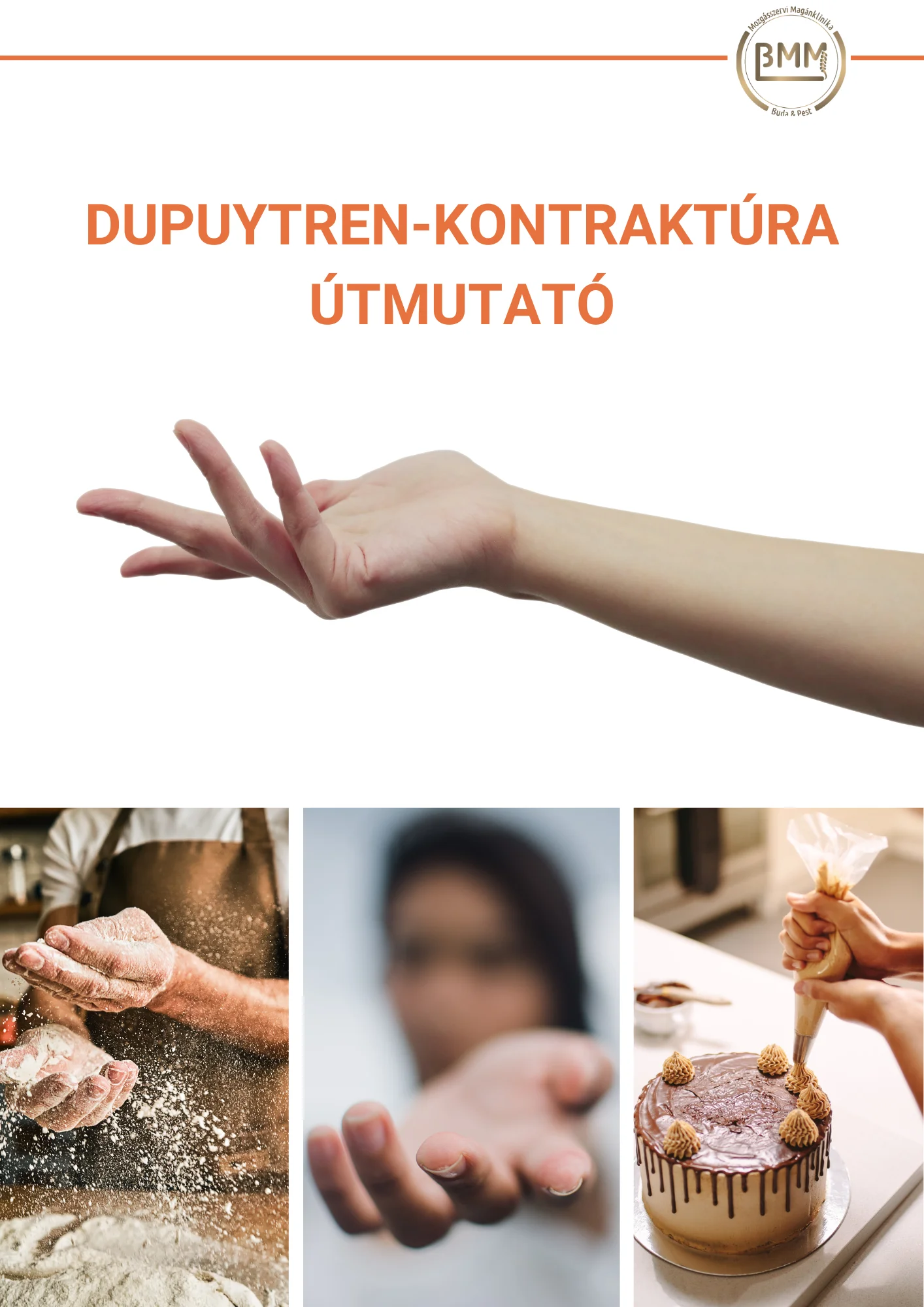 Dupuytren-kontraktúra útmutató