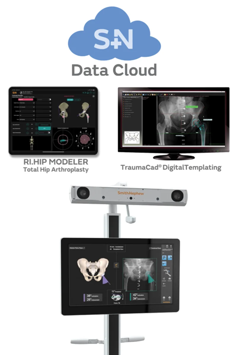 Robotasszisztált térdprotézis műtétet segíti a fejlődő képalkotó rendszer