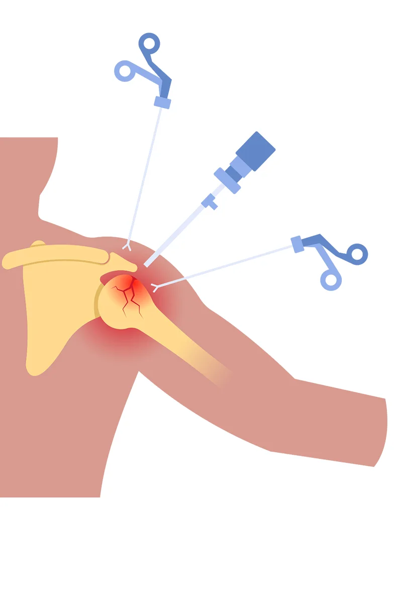 Felsővégtagi artroszkópos műtét illusztrációja: vállartroszkópia során használt sebészeti eszközök a vállízület kezelésére.